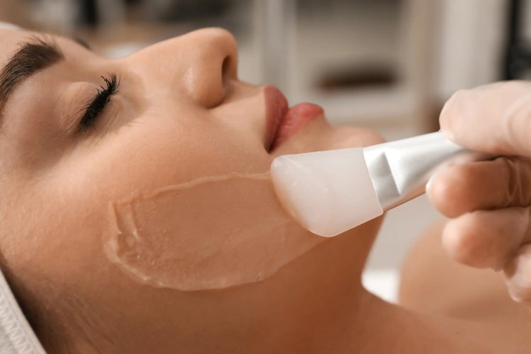 What is a Level 4 chemical peel?