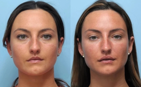 Thread Lift Excellence with the Best Plastic Surgeon in Dubai