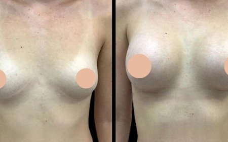 Breast Enhancement Surgery in Dubai: How the Procedure Enhances Feminine Curves