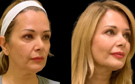 Cheek Fillers Treatment in Dubai: Is It a Trend or Here to Stay?