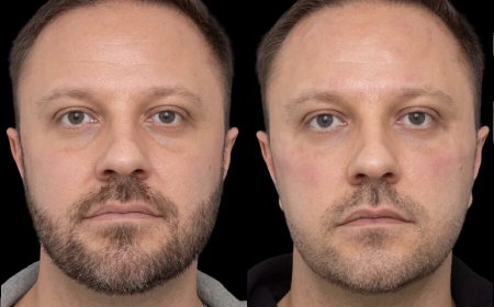 Under Eye Fillers Treatment in Dubai: What Makes It Unique