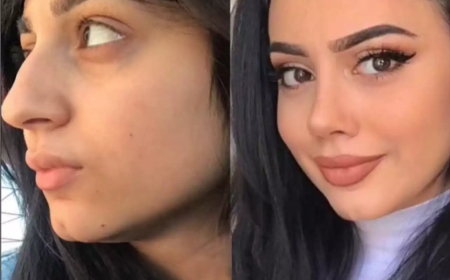 Comparing the Best Rhinoplasty Surgeons in Dubai: Who Stands Out?