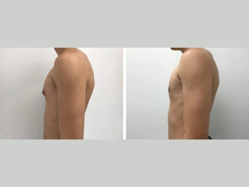 How to Choose the Right Gynecomastia Surgeon in Dubai